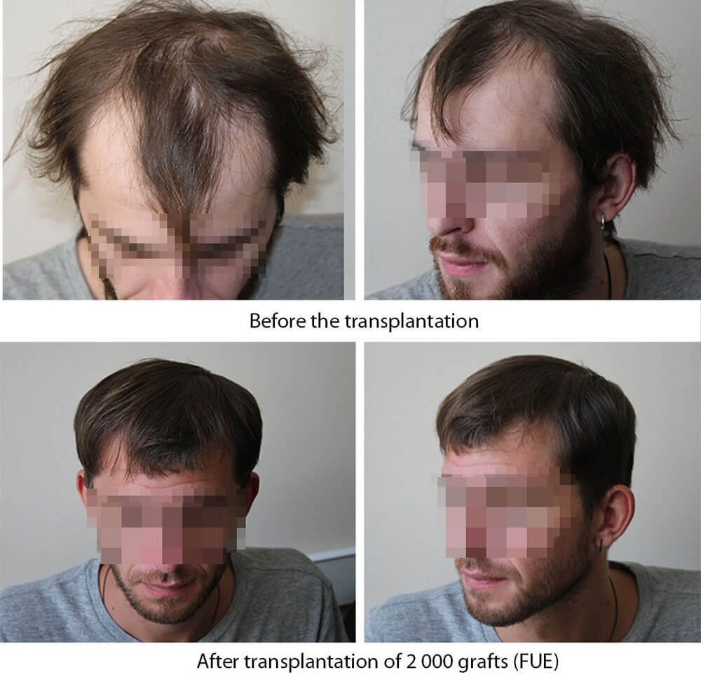 long hair transplant before after