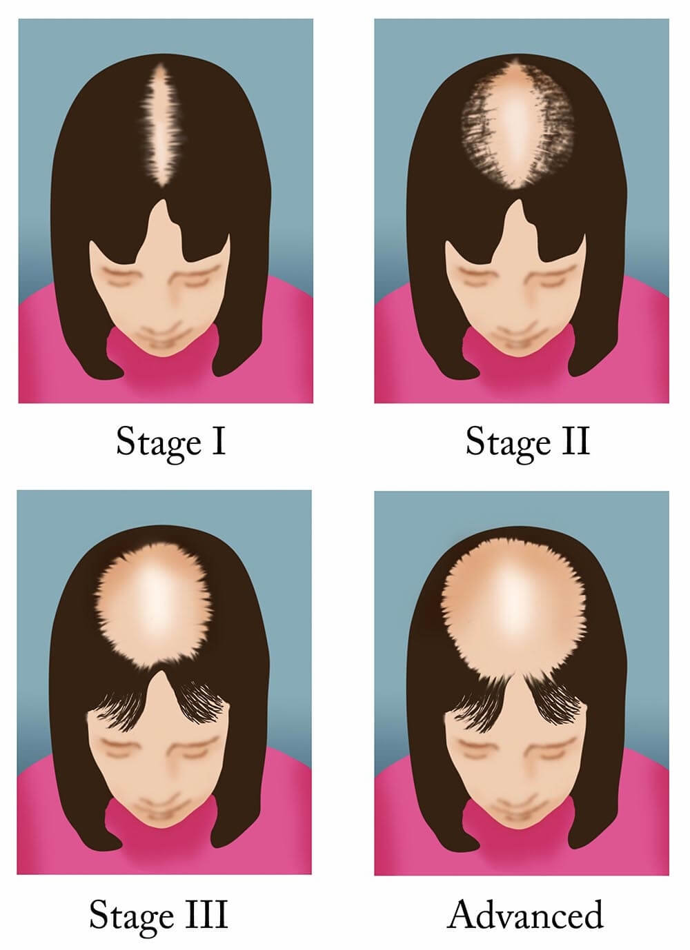 Male Pattern Hair Loss in Women