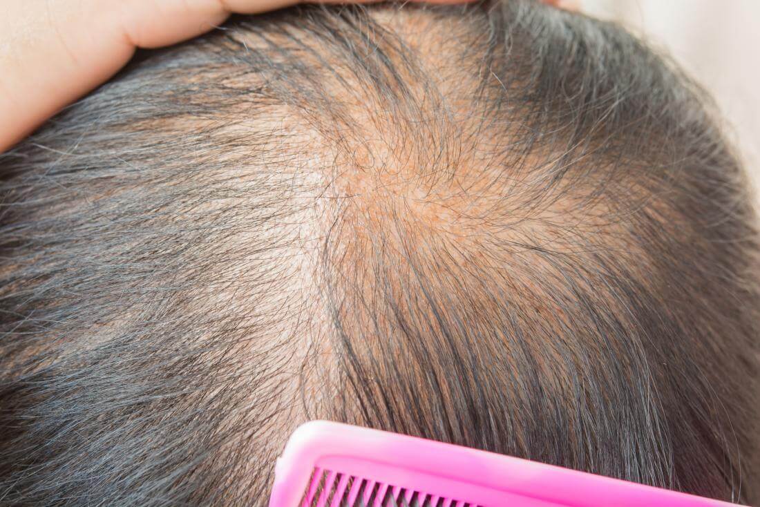 male pattern hair loss woman