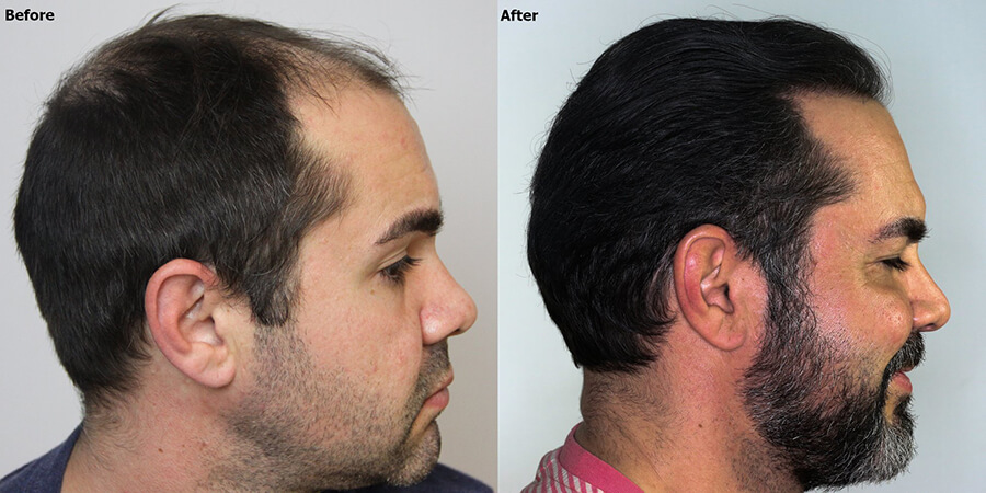 men good hair transplant before after
