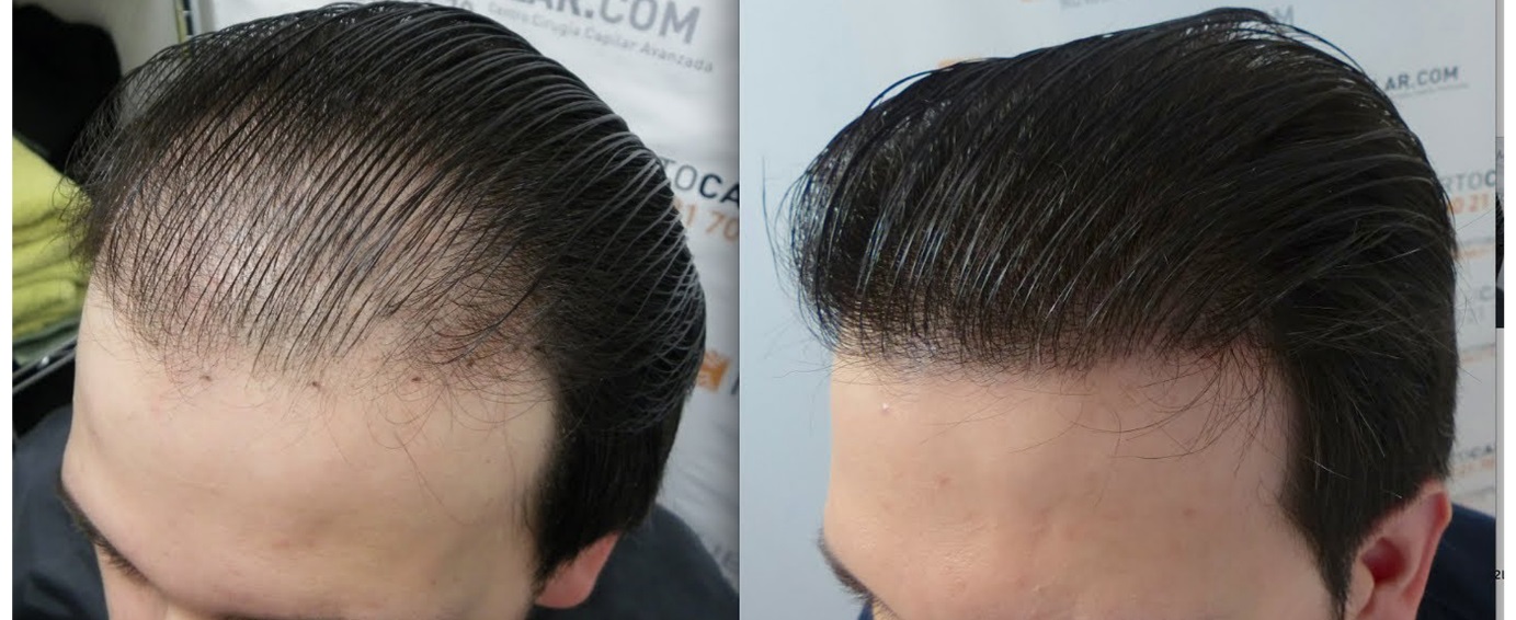 methods to get a thicker hair