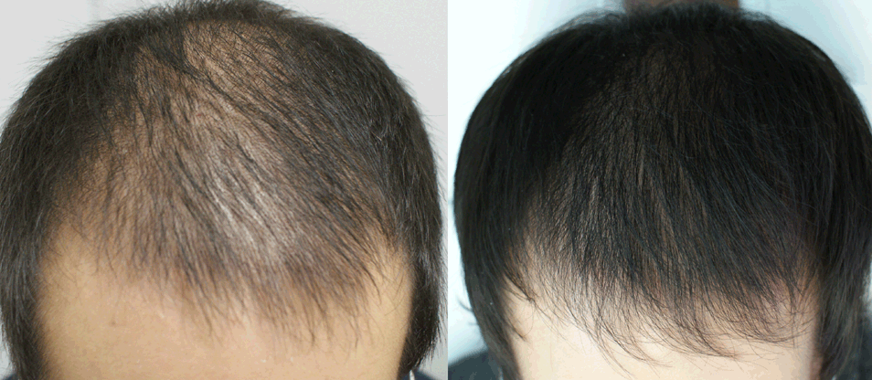 méthodes pour augmenter la densité des cheveux