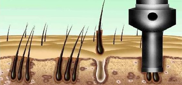 Resultados del trasplante de cabello con micromotor