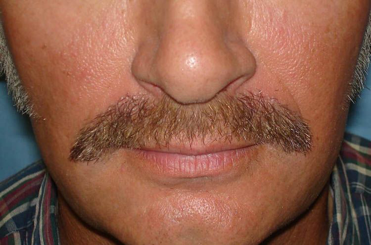 mustache transplant before after photos