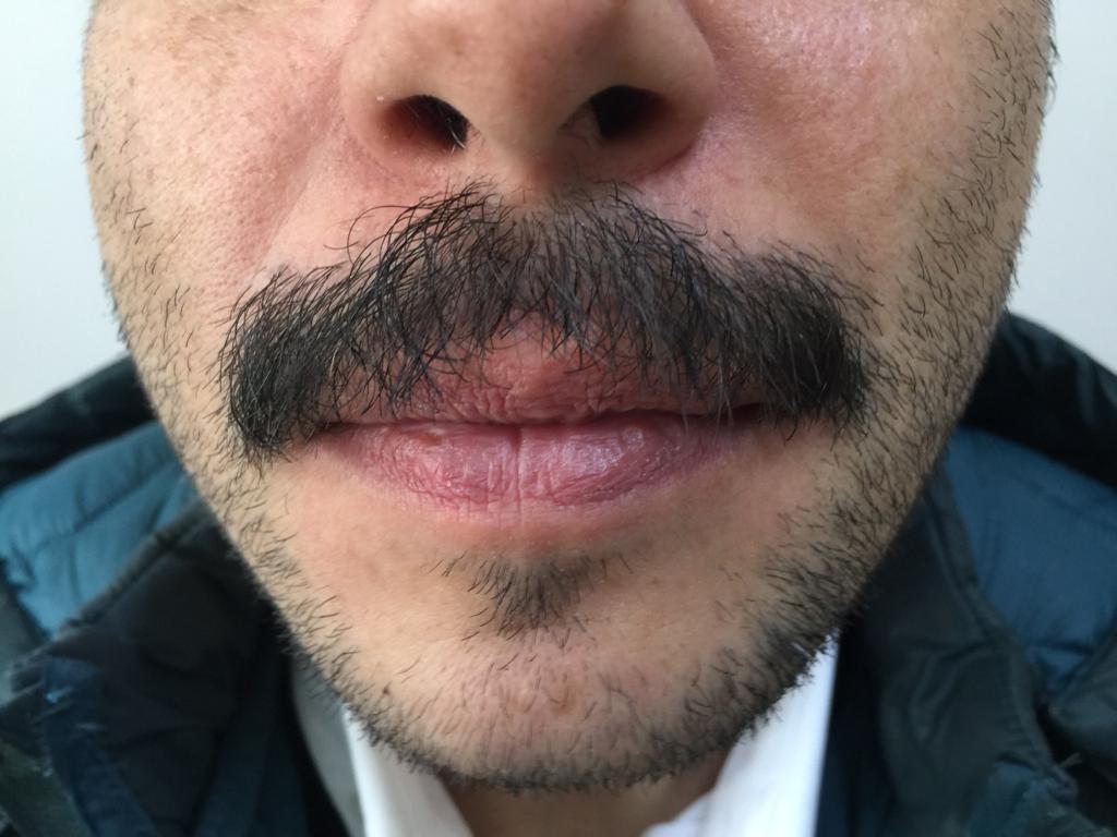 resultado de trasplante de bigote