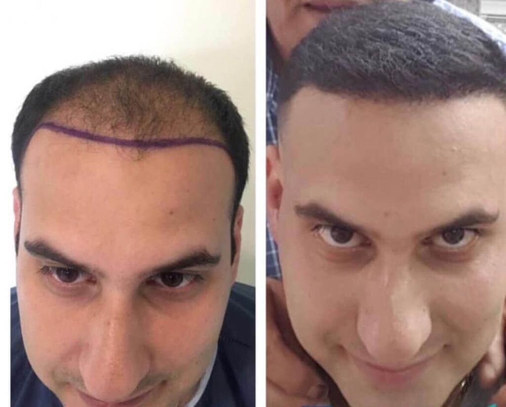 natural hair transplant before after