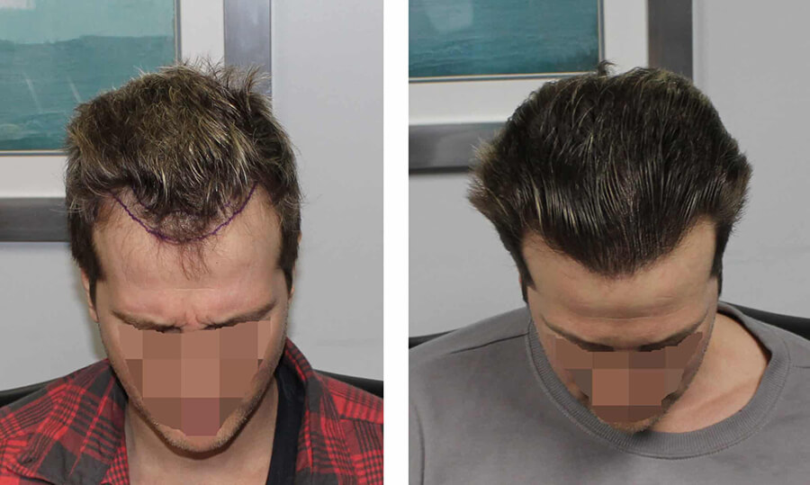 natürliche Haartransplantation vor nach dem Foto