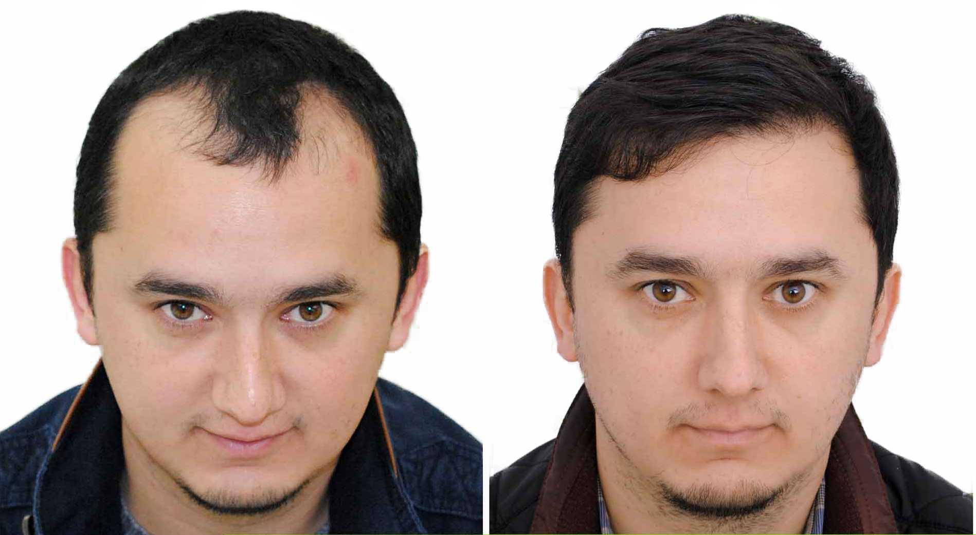 natural hair transplant result