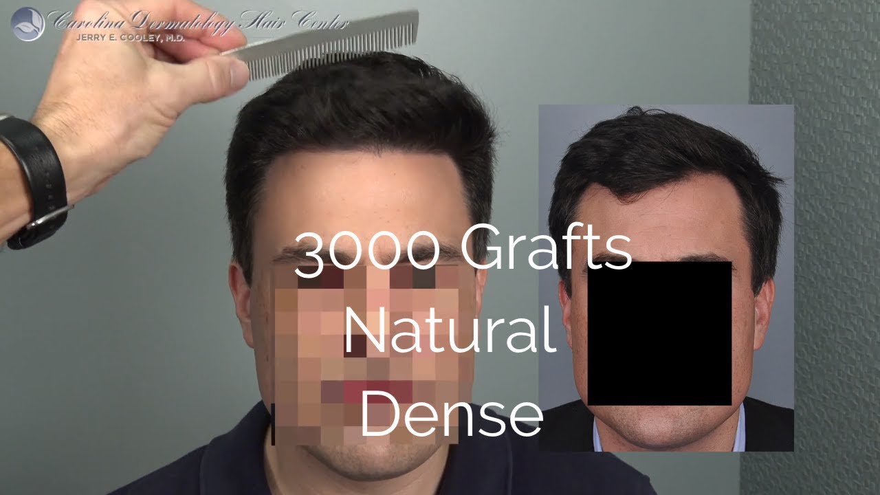 résultats de greffe de cheveux naturels