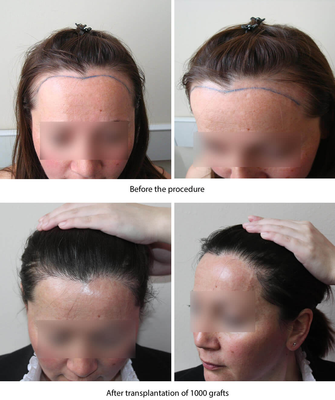 trasplante de cabello natural mujer antes después