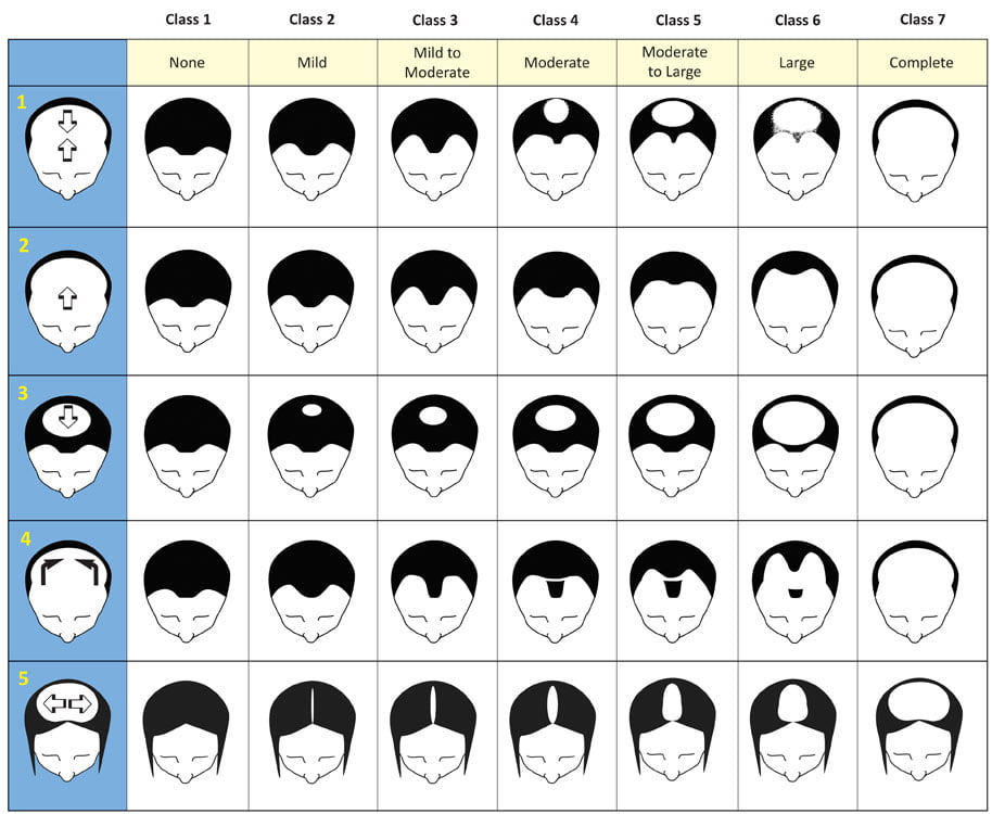 norwood scalehair loss