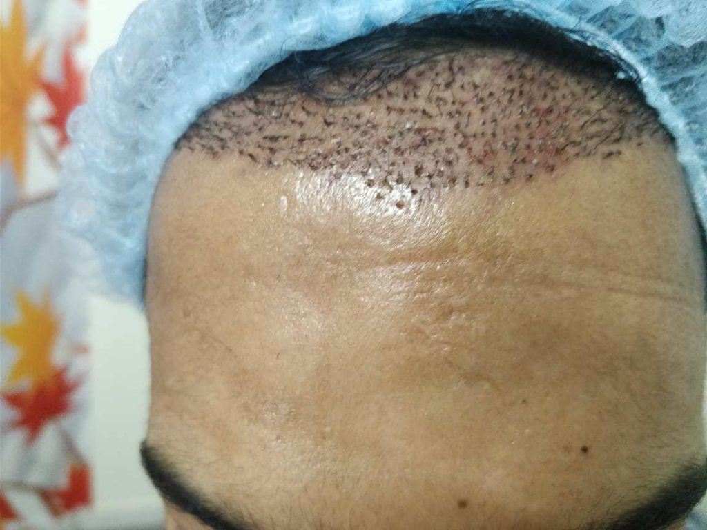 numbness after hair transplant