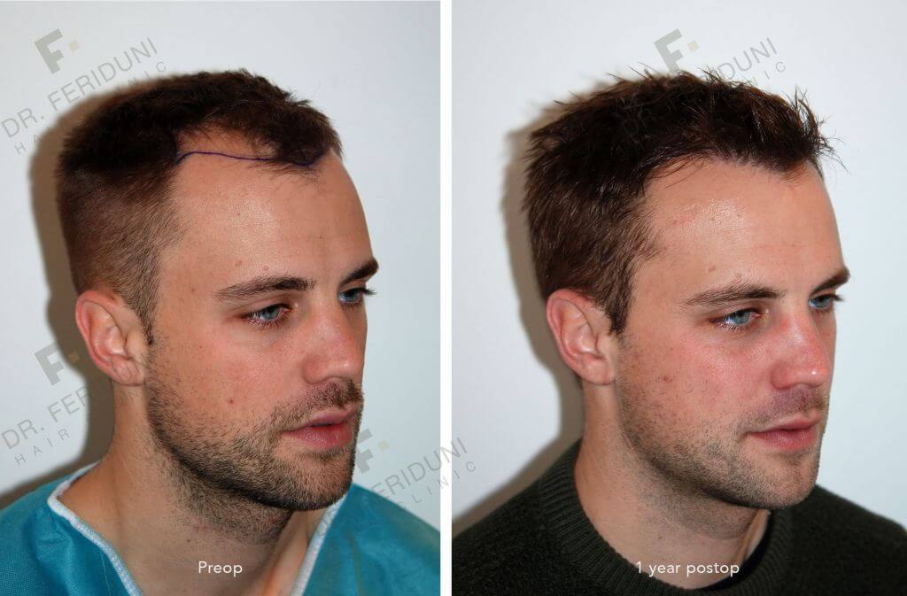 photos of hair transplant before after