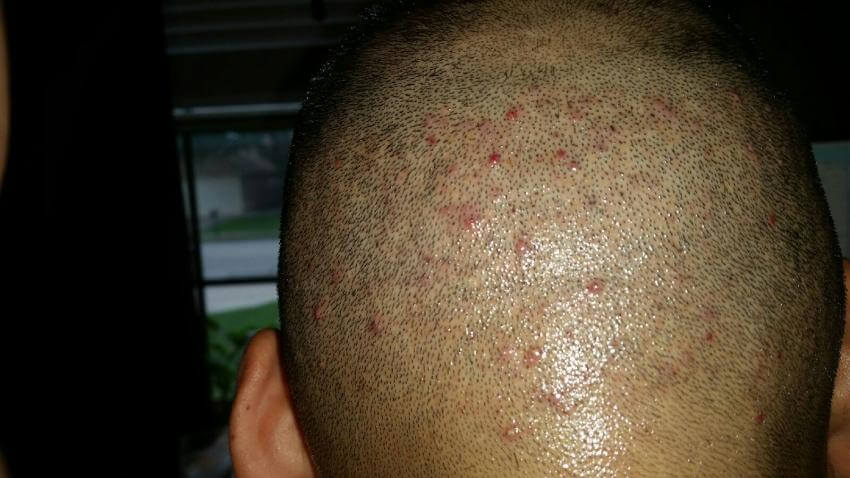 pimples after hair transplant