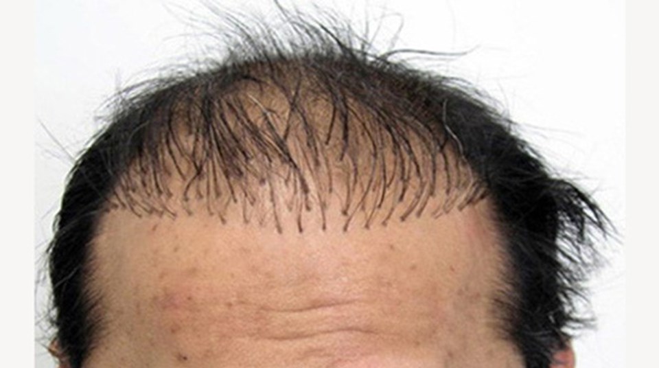 capelli arruffati dopo un cattivo trapianto di capelli