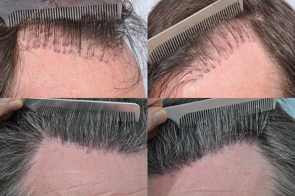 Pluggy Haartransplantation vorher nachher