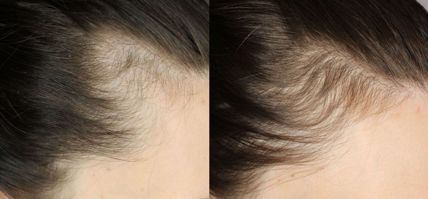 pregnant womanhair loss before after