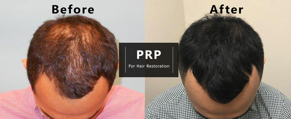 PRP-Behandlung