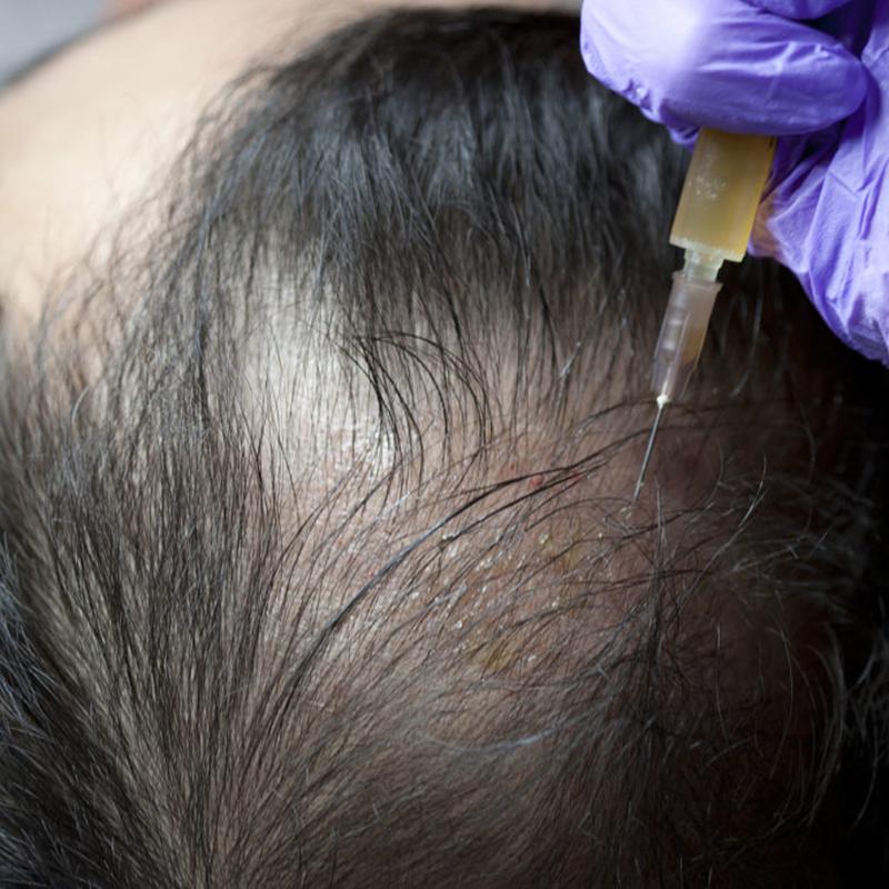 prp treatmentfue hair transplant results