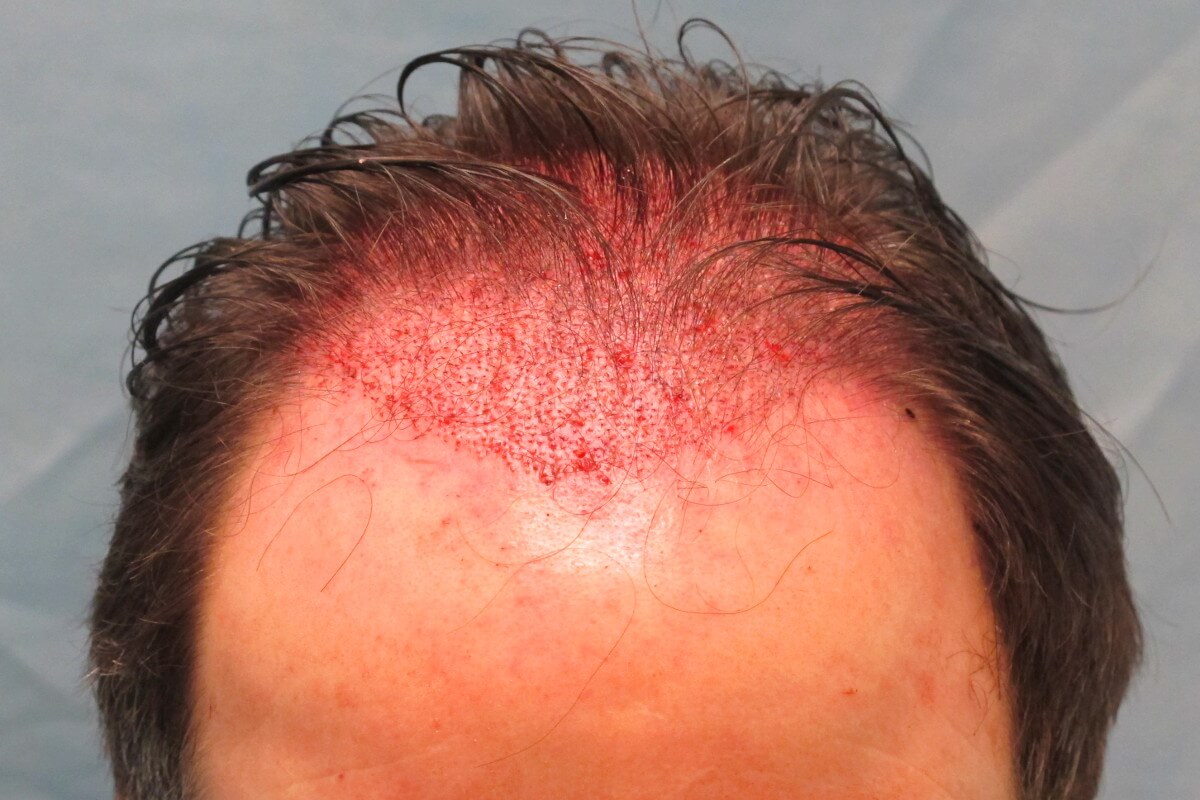 redness after hair transplant