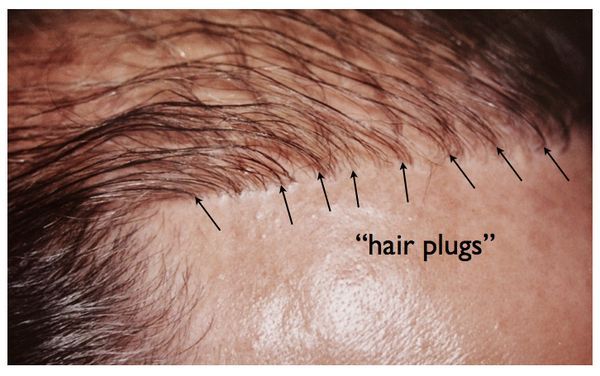 Reparatur einer schlechten Haartransplantation