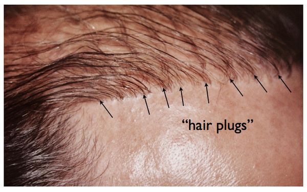 repairing a bad hair transplant