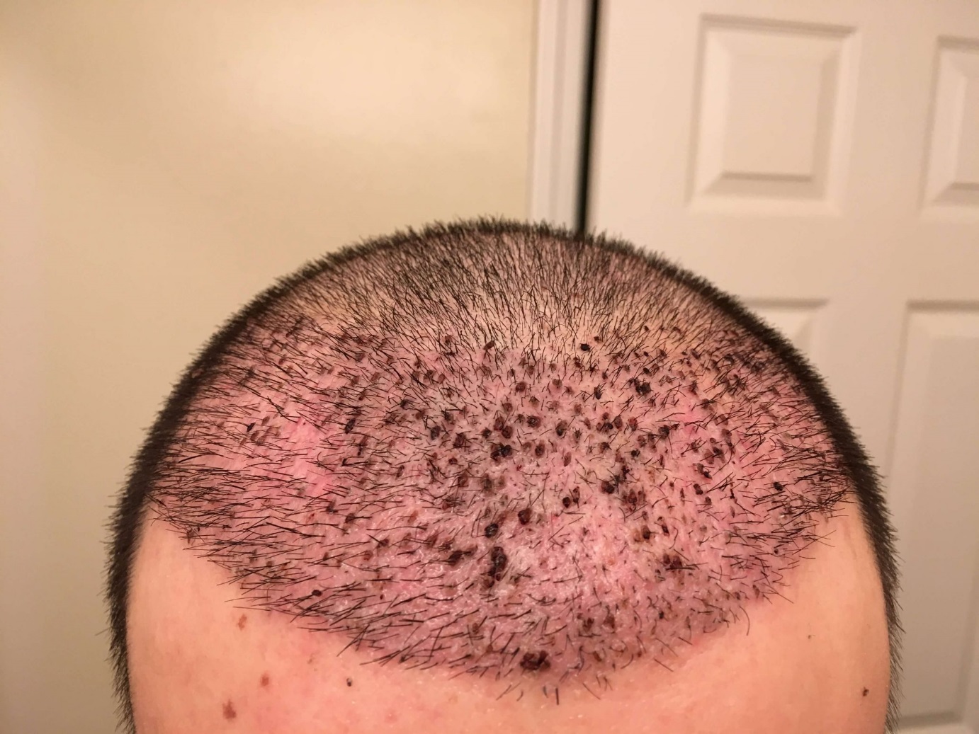 scabbing after hair transplant