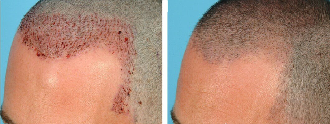 scabs after hair transplant