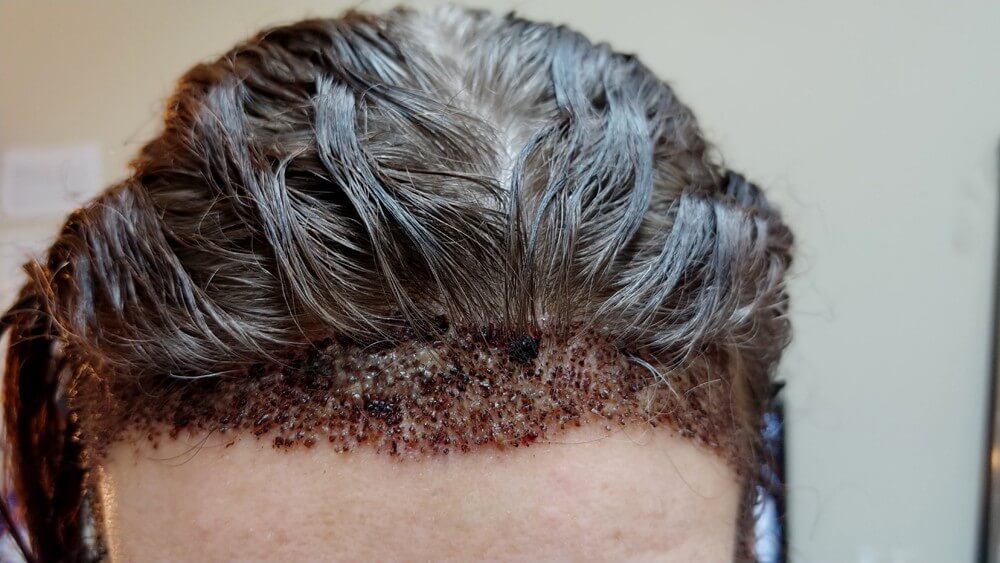 Krusten nach Haartransplantation