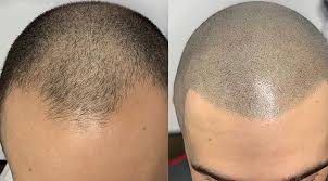 scalp micropigmentation