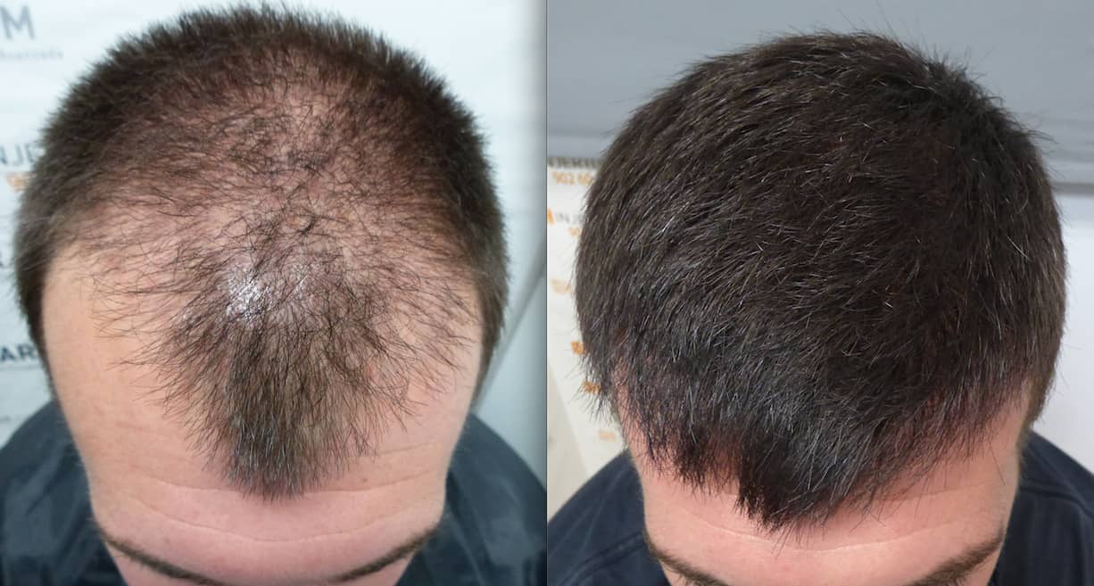 second hair transplant before after