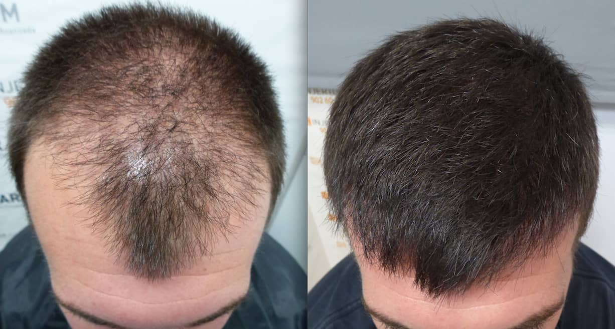 zweite Haartransplantation vorher nachher