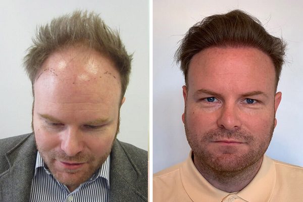 second hair transplant photos