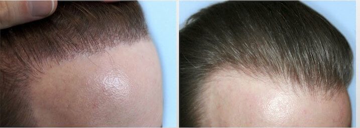 zweite Haartransplantation