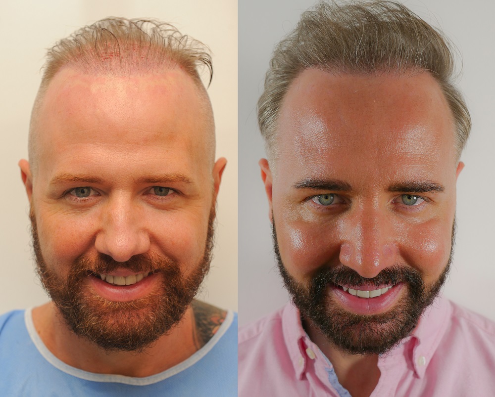 second hairtransplant examples