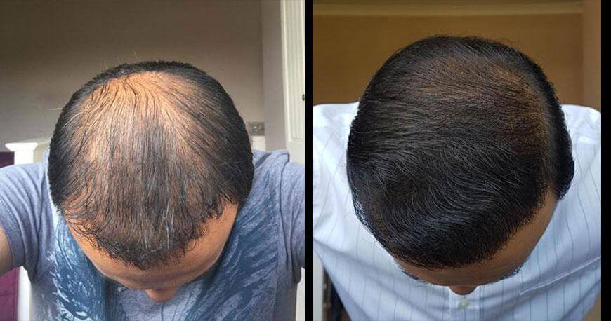 resultados del trasplante de segundo cabello