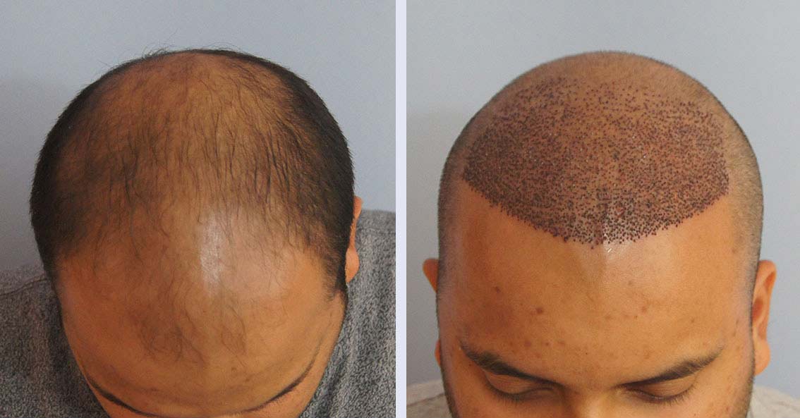 Sex nach Haartransplantation