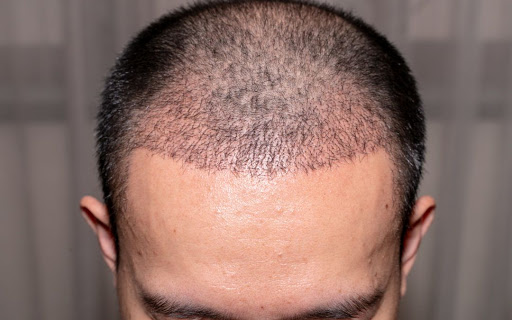 shock hair loss after hairtransplant