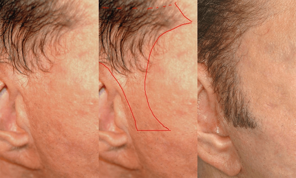 sideburn transplant before after