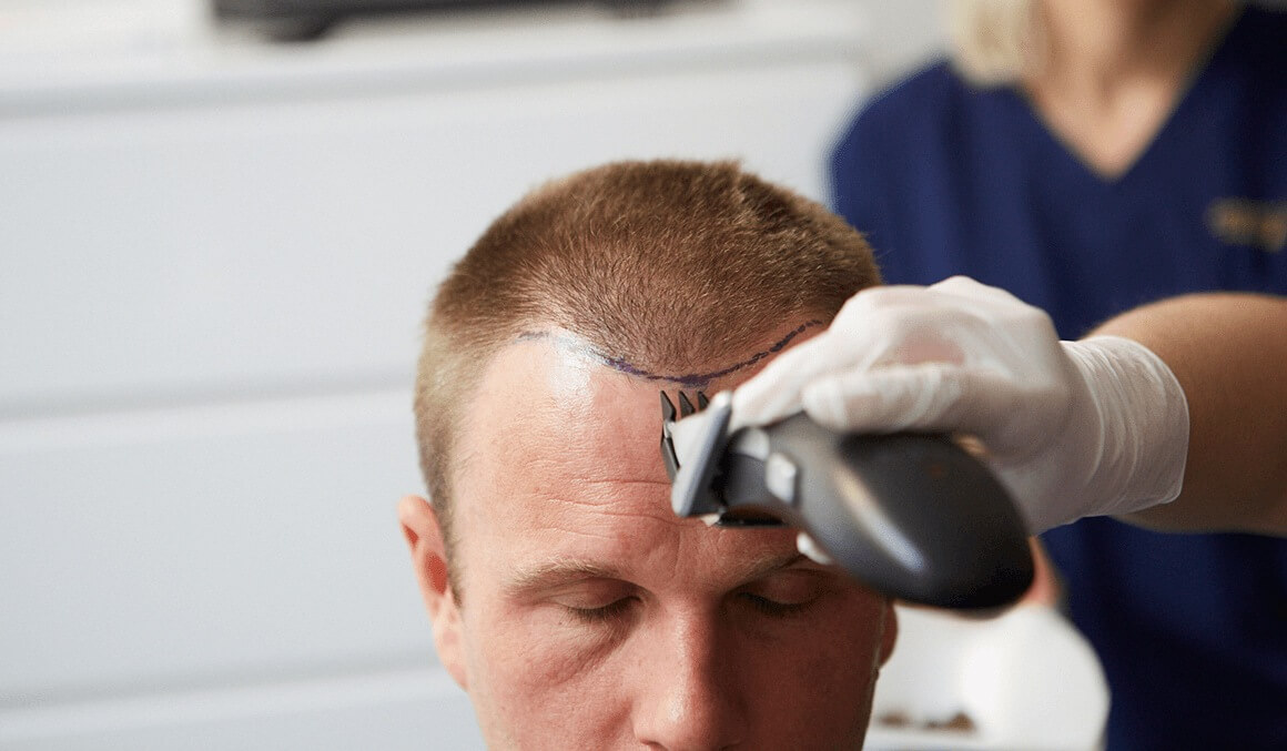 stages of a hair transplant