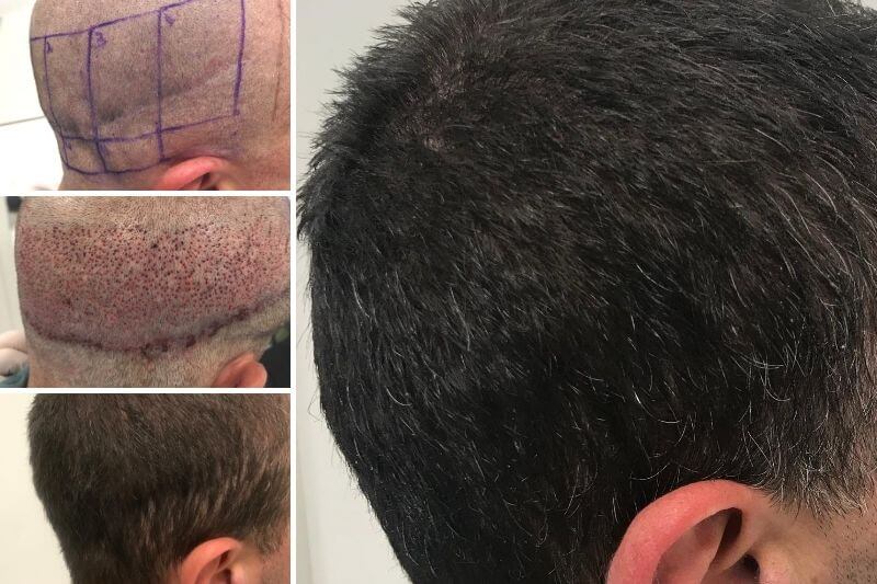 step by step hair transplant before after