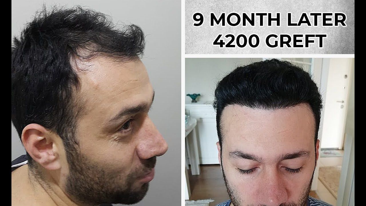 success rate in hair transplant_2