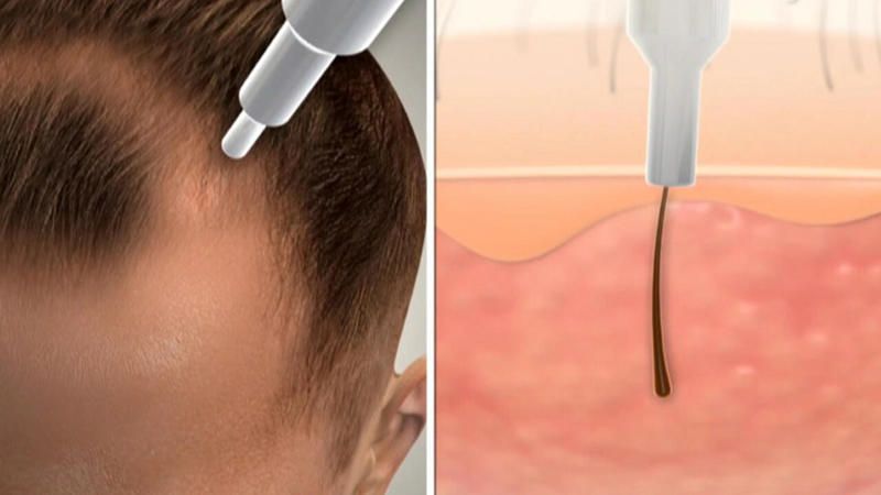 Erfolgsrate bei Haartransplantation