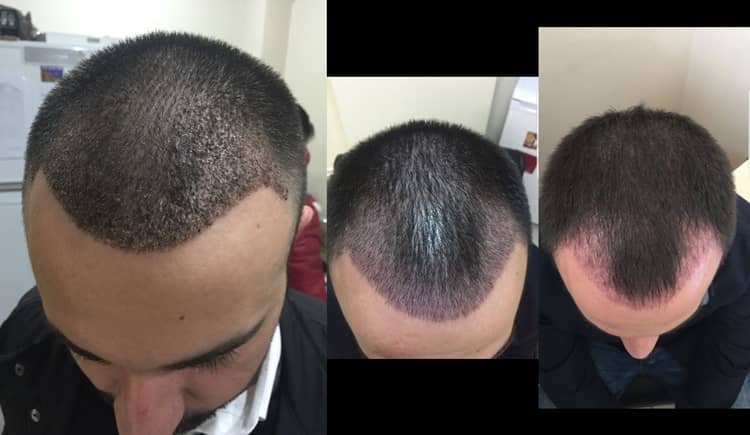 successful hair transplant