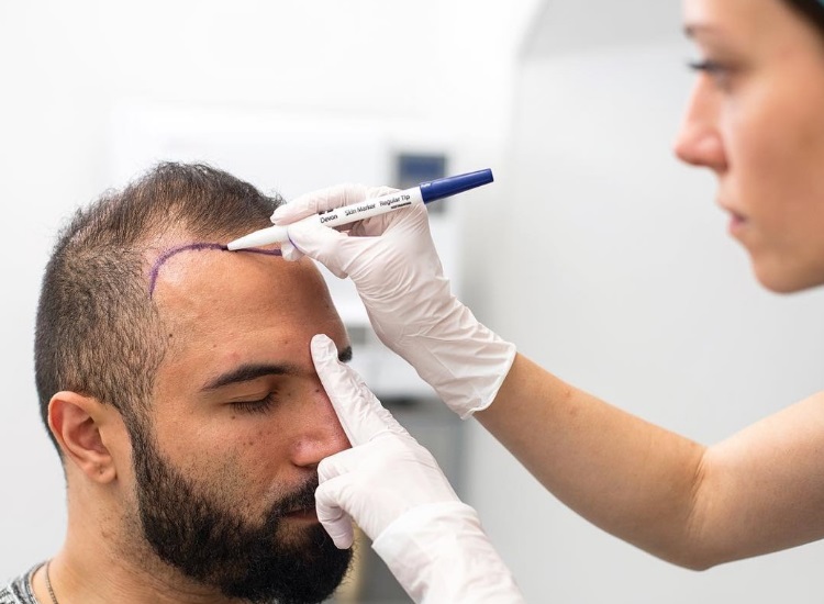 Behandlungen für genetischen Haarausfall