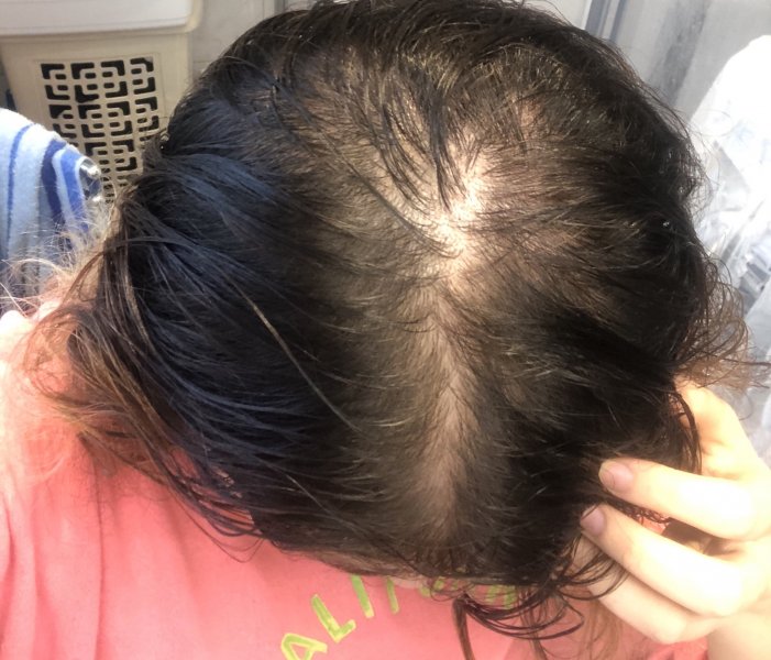 trattamentiper la caduta dei capelli di tipo femminile