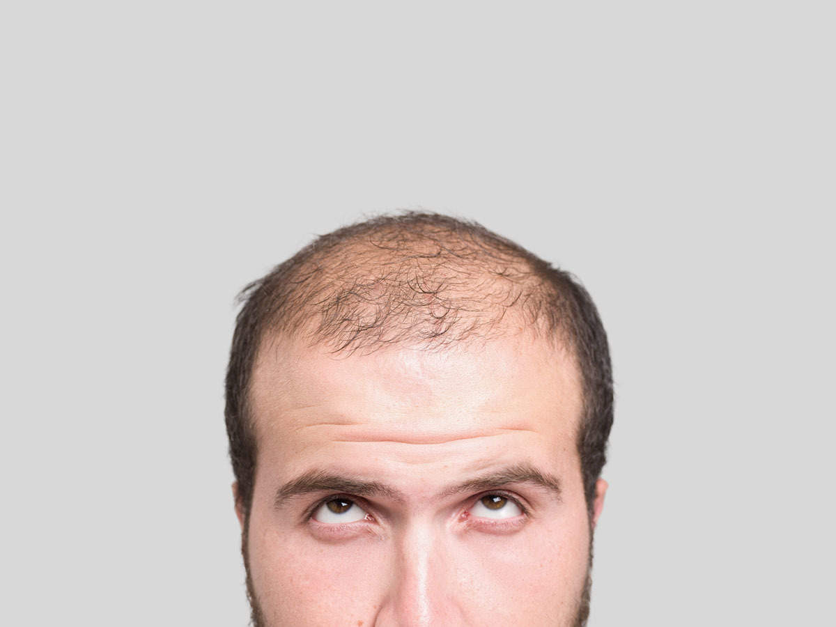 types of hair loss