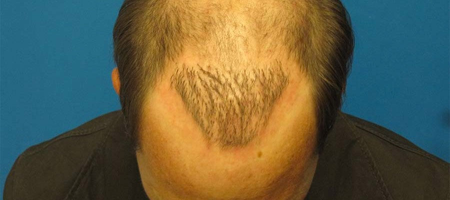 résultats de greffe de cheveux insatisfaisants