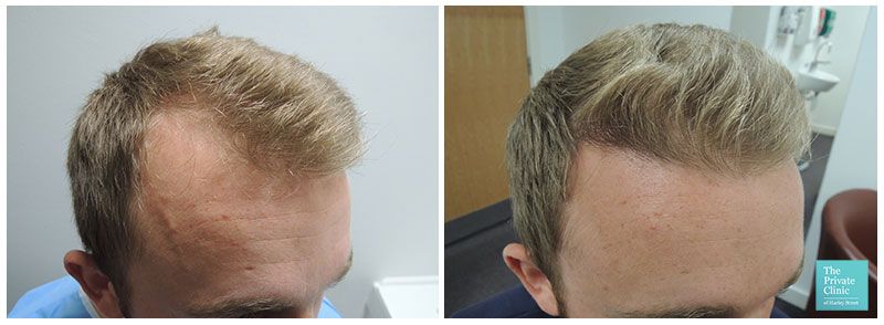 resultados del trasplante de cabello sin afeitar