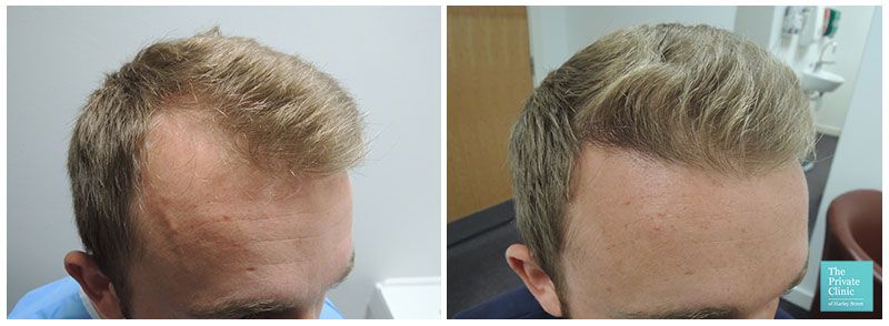 Ergebnisse einer unrasierten Haartransplantation